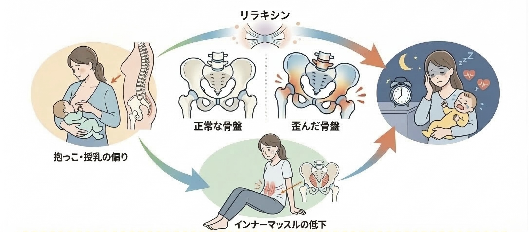 産後の骨盤の歪みイメージ